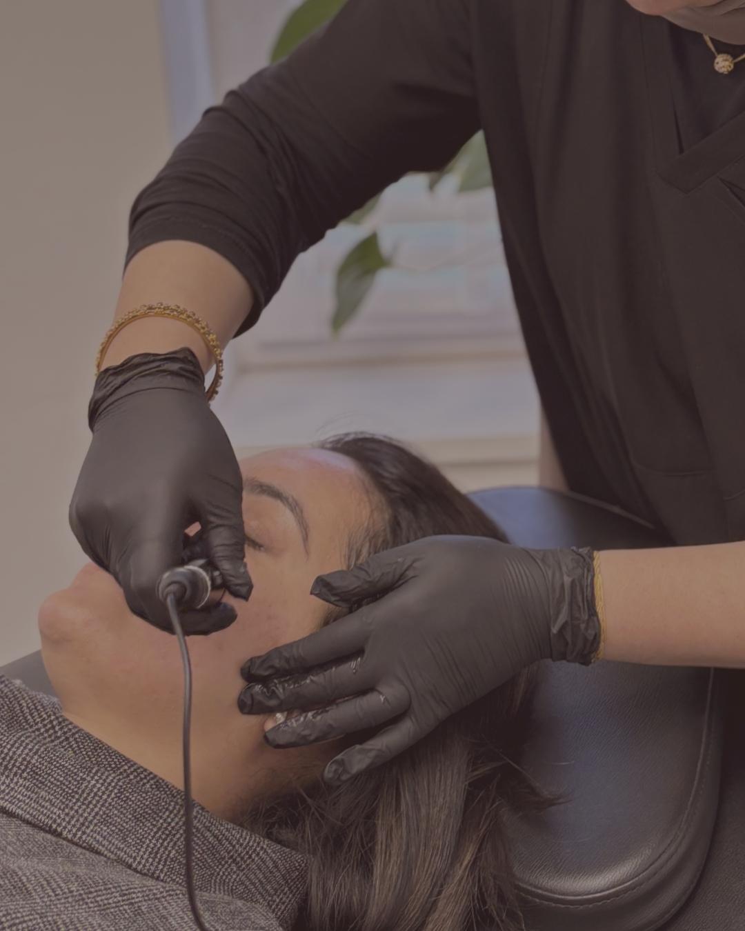 Aesthetic microneedling treatment at Dr Khan Clinics Marlow